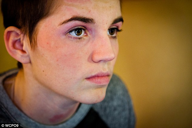 بهبود باورنکردنی دختر 16 ساله پس از آتش سوزی، تنها بعد از دو ماه