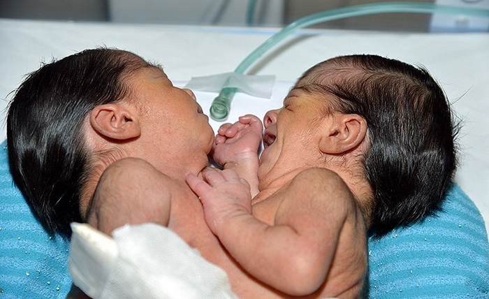 (تصاویر) تولد دوقلوی به‌هم چسبیده در شیراز