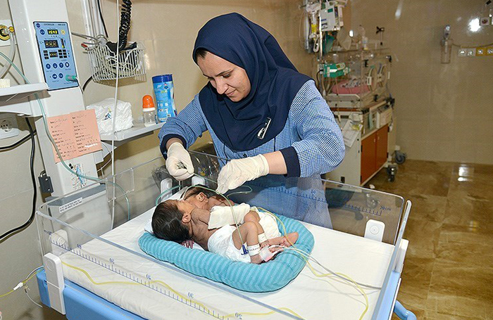 (تصاویر) تولد دوقلوی به‌هم چسبیده در شیراز