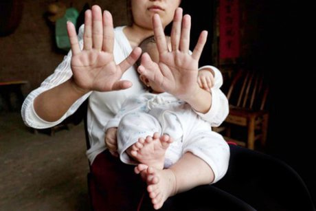(تصویر) این کودک 31 انگشت دارد