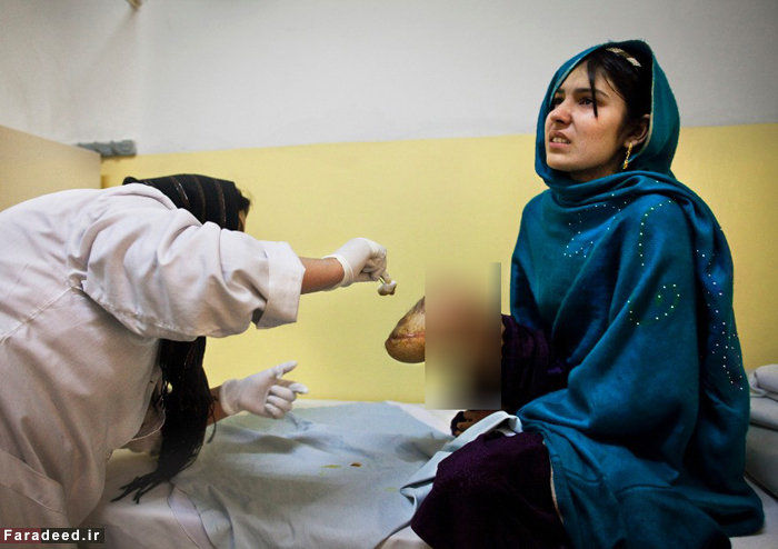 (تصاویر) زخم‌هایی بر تن زنان افغان