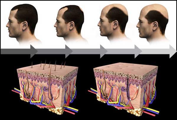 راه حل‌های درمان ریزش مو در مردان