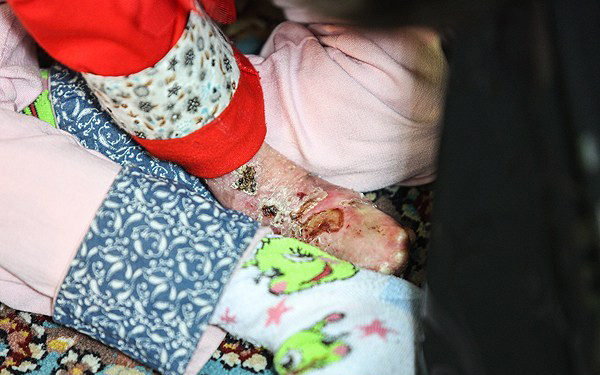 (تصاویر) این کودکان با چرک و زخم زندگی‌ می‌کنند