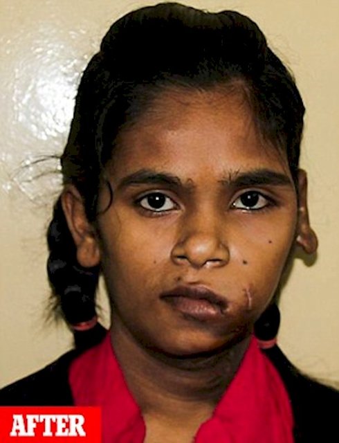 (عکس) خروج تومور ۲.۸ کیلویی از صورت دختر هندی