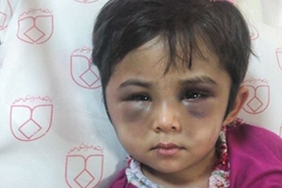 (عکس) کودک آزار دیده با صورت کبود