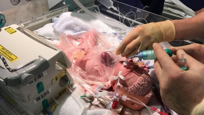 (تصاویر) نجات نوزادی که قلبش بیرون بدنش بود