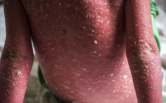 (تصاویر) بیماری پوستیِ نرگس