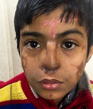 (تصاویر)عجیب‌ترین پیوند بینی روی صورت یک نوجوان