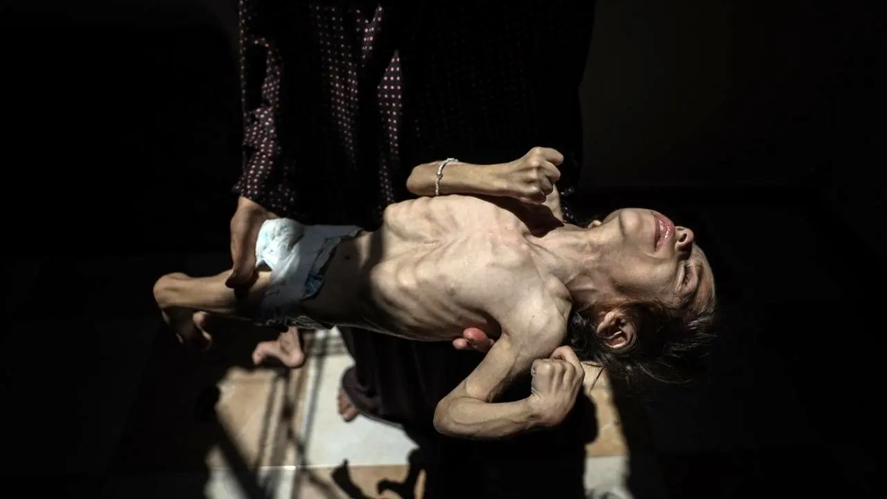 تصاویر دلخراش از دختر ۶ ساله فلسطینی با ۴ کیلو وزن