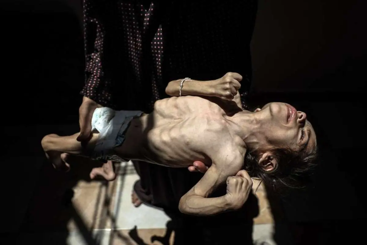 تصاویر دلخراش از دختر ۶ ساله فلسطینی با ۴ کیلو وزن