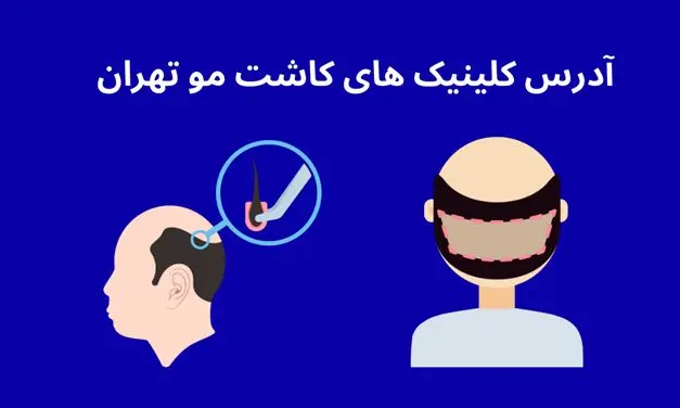 آدرس کلینیک های کاشت مو در تهران [ 10 مرکز فوق تخصصی ] 