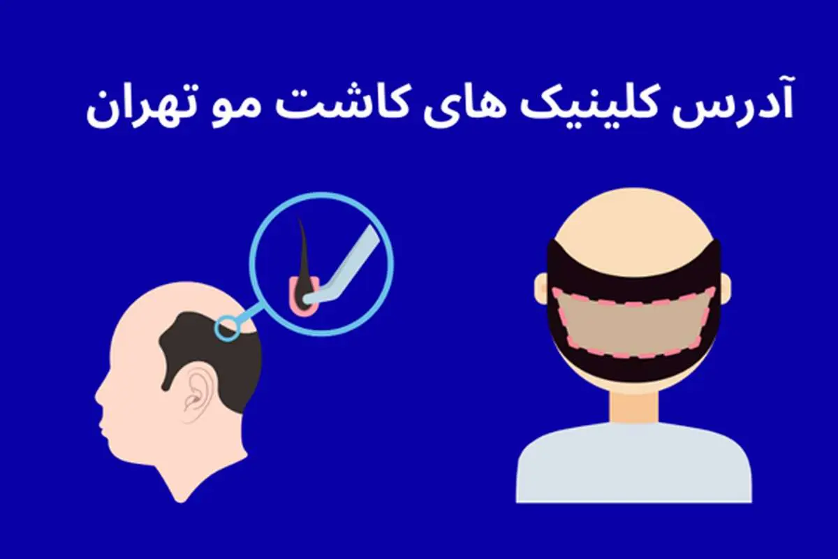 آدرس کلینیک های کاشت مو در تهران [ 10 مرکز فوق تخصصی ] 