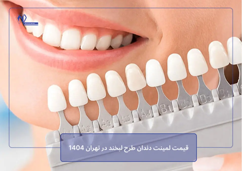 قیمت لمینت دندان طرح لبخند