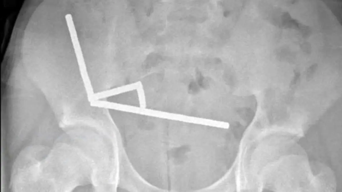 بلع ۲۰۰ آهنربا نوجوان نیوزیلندی را راهی اتاق عمل کرد!