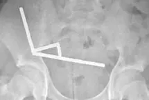 بلع ۲۰۰ آهنربا نوجوان نیوزیلندی را راهی اتاق عمل کرد!