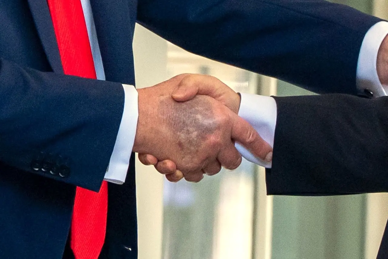 ترامپ در تلاش برای پنهان کردن کبودی مزمن دست راست