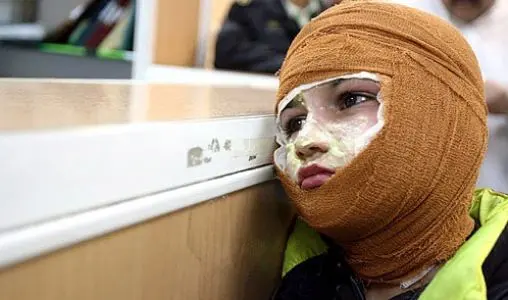 میزان سوختگی در ایران ۸ برابر میانگین جهانی/ ۳۰۰۰ نفر جان خود را از دست می‌دهند