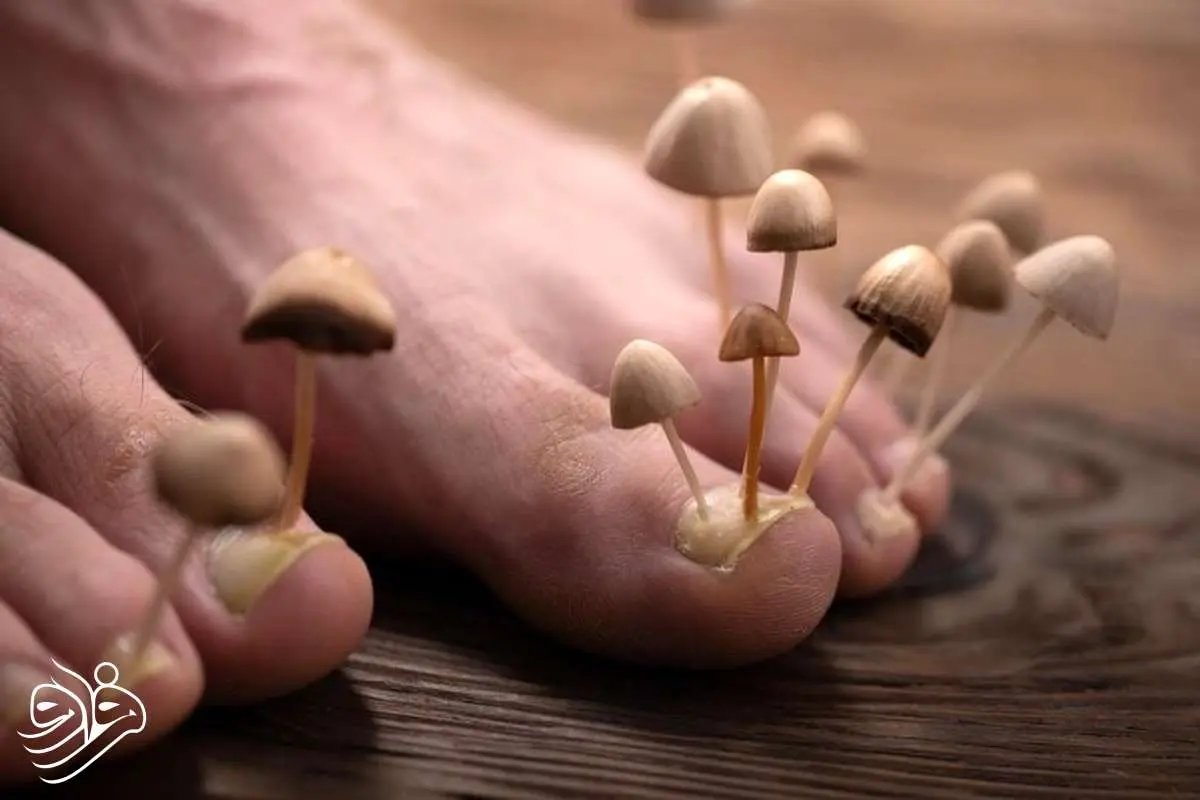 تخم‌مرغ گندیده، قاتل قارچ‌های ناخن!