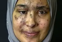 تصاویر؛ پرتره‌هایی از بازماندگان انفجار مرگبار پیجرهای حزب‌الله