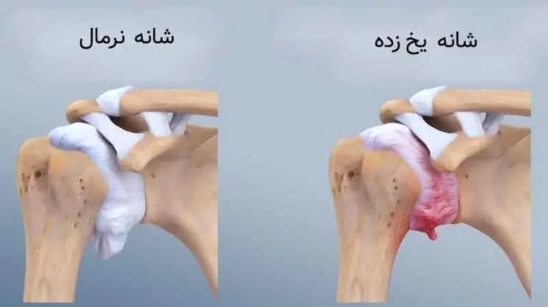 شانه یخ زده