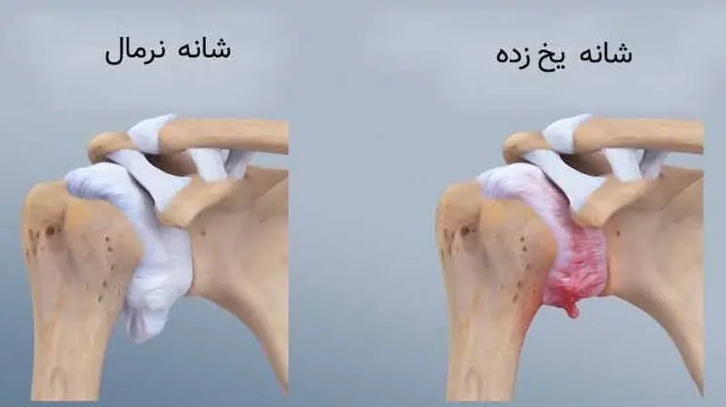 شانه یخ زده