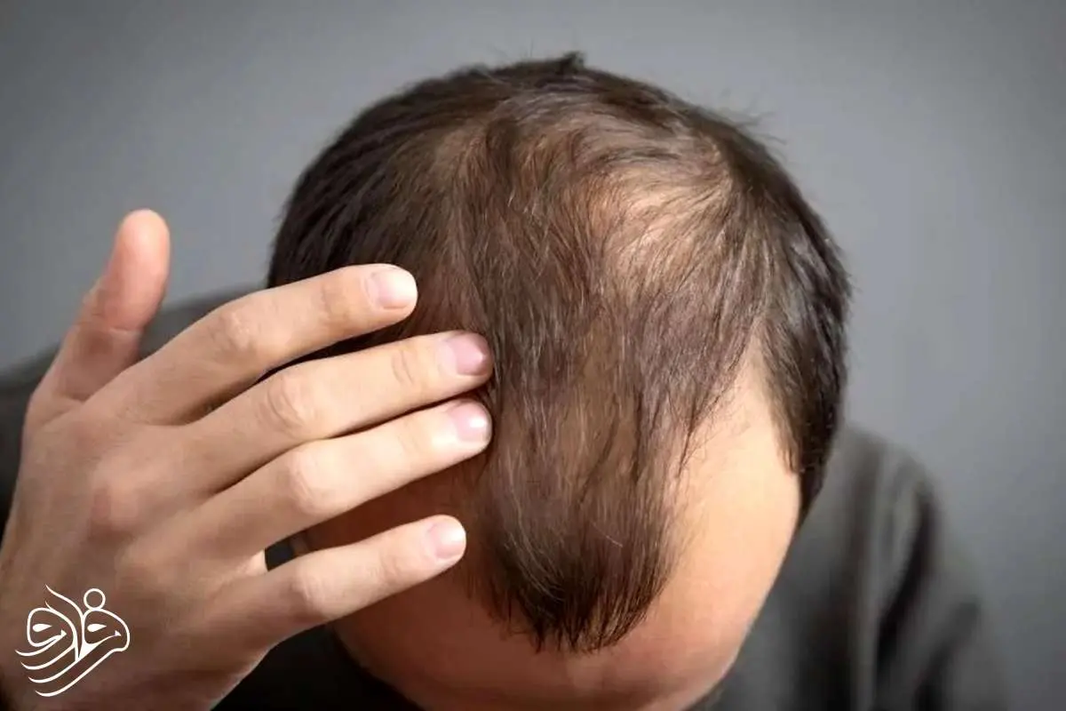 کشف سرم معجزهآسای رشد مو در ۲۰ روز توسط دانشمندان تایوانی