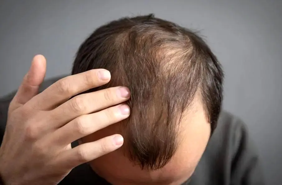 کشف سرم معجزه‌آسای رشد مو در ۲۰ روز توسط دانشمندان تایوانی