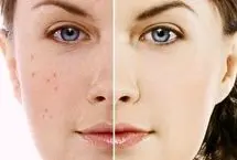 با این ماسک‌های خانگی، جوش‌هایتان را درمان کنید