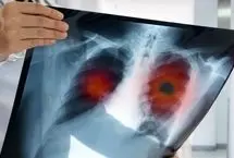 علائم اولیه سرطان ریه: این نشانه‌ها را جدی بگیرید!