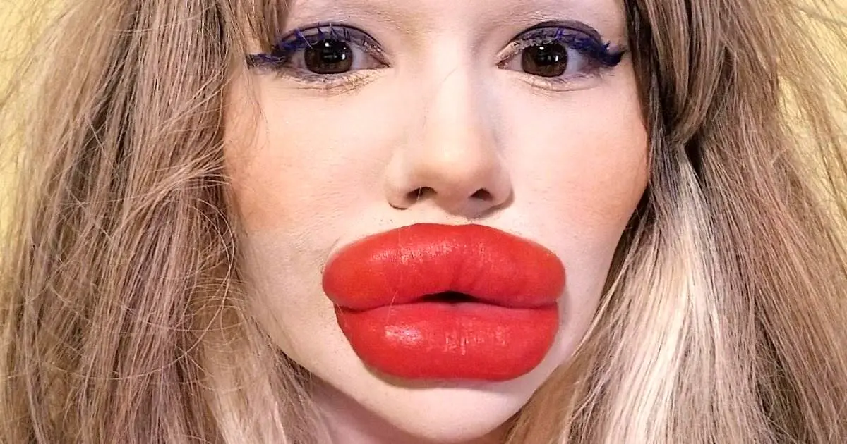 زنی که هزاران پوند خرج کرد تا بزرگترین لب دنیا را داشته باشد