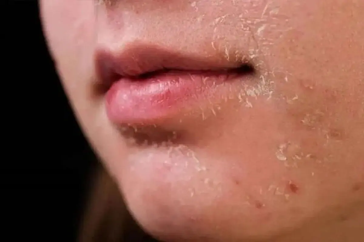 چرا پوست صورت خشک می‌شود؟ از هوای سرد و شست‌وشوی زیاد تا بیماری‌های زمینه‌ای