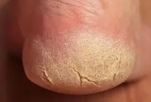 چطور ترک پاشنه پا را درمان کنیم؟