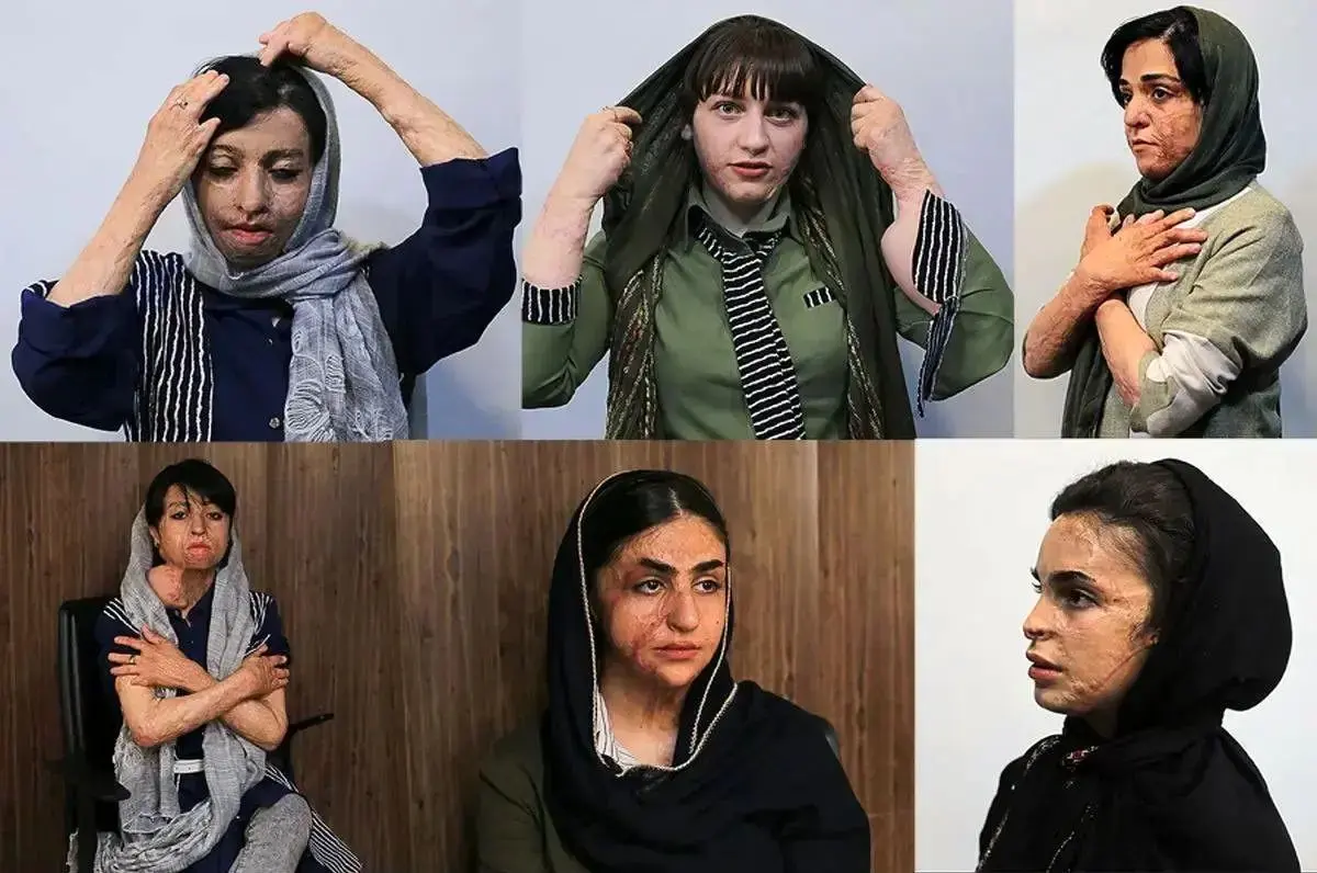دختران سوخته شین‌آباد این روزها چه می‌کنند