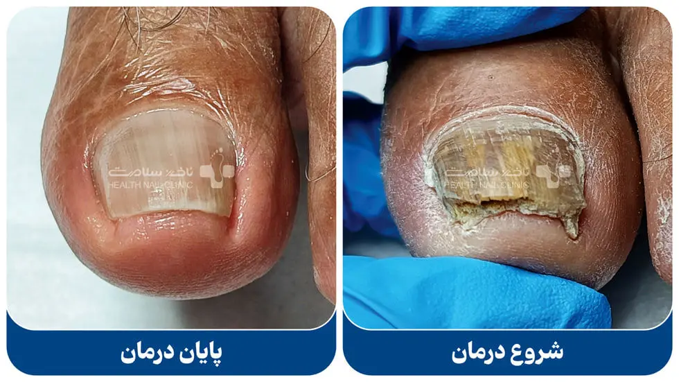 درمان خانگی فرو رفتن ناخن پا در گوشت