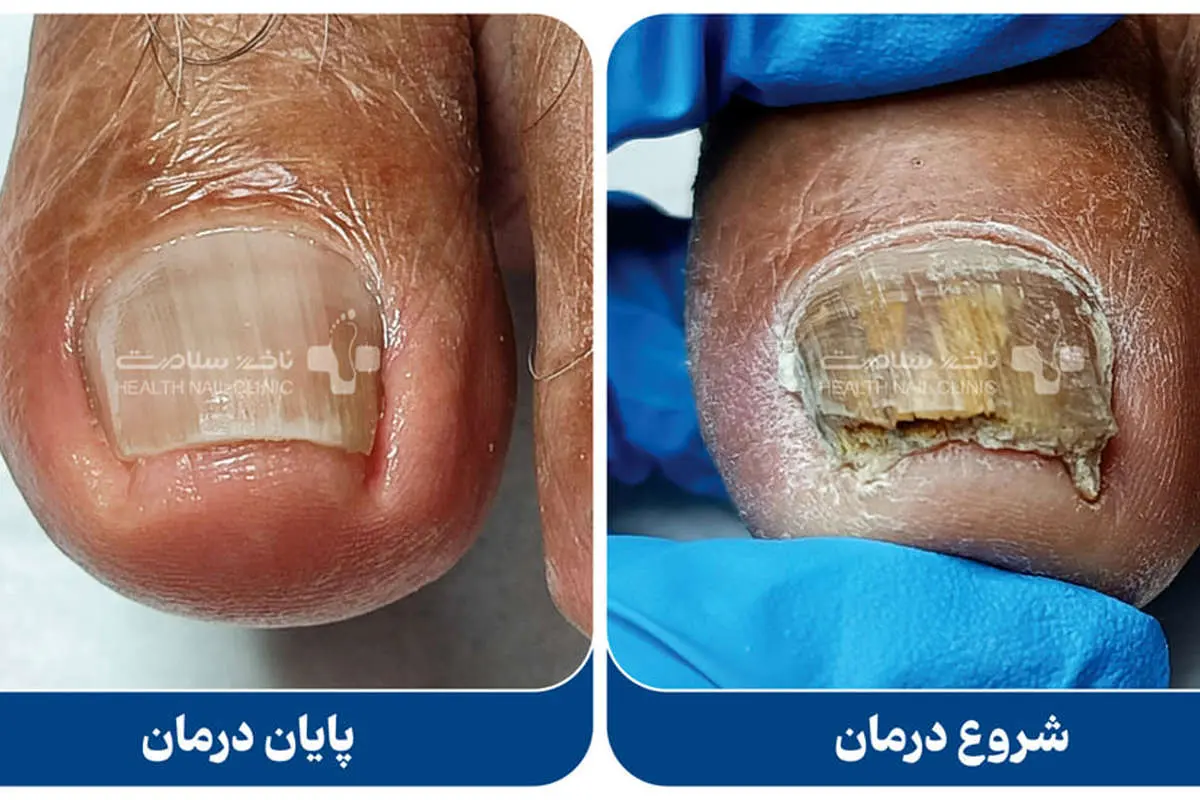 درمان خانگی فرو رفتن ناخن پا در گوشت