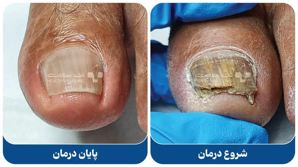درمان خانگی فرو رفتن ناخن پا در گوشت