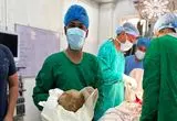 خارج کردن سنگ مثانه به وزن ۳.۱ کیلوگرم از بدن بیمار ۵۵ ساله