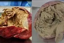 ببینید؛ جنین مومیایی شده از بدن یک زن سالمند خارج شد