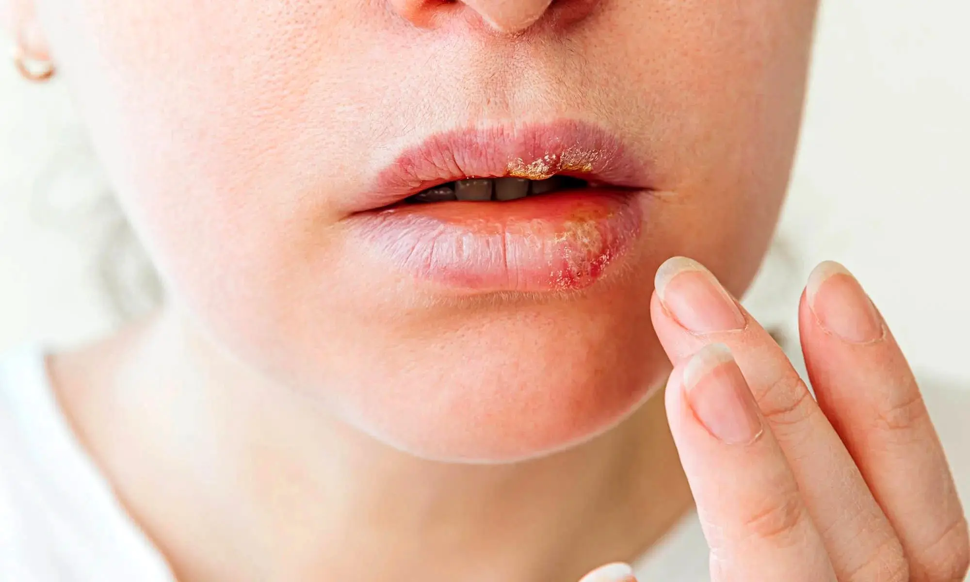 تبخال لب تا چه زمانی واگیر دارد؟