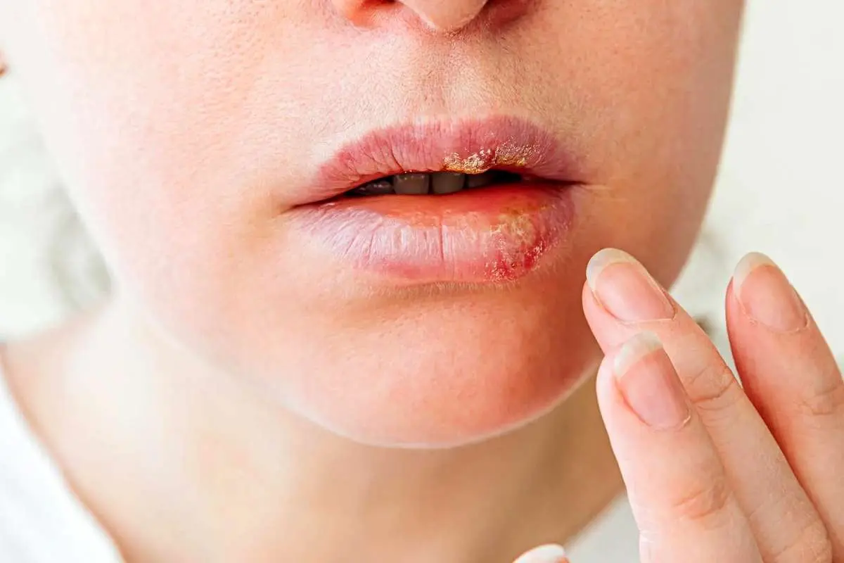 تبخال لب تا چه زمانی واگیر دارد؟