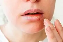 تبخال لب تا چه زمانی واگیر دارد؟