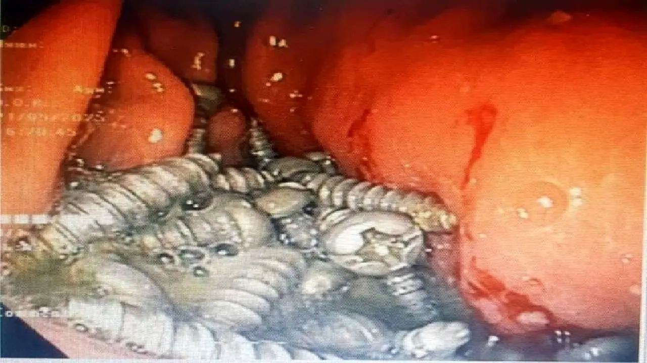 خارج کردن ۴۷ پیچ از معده یک بیمار در کرج!