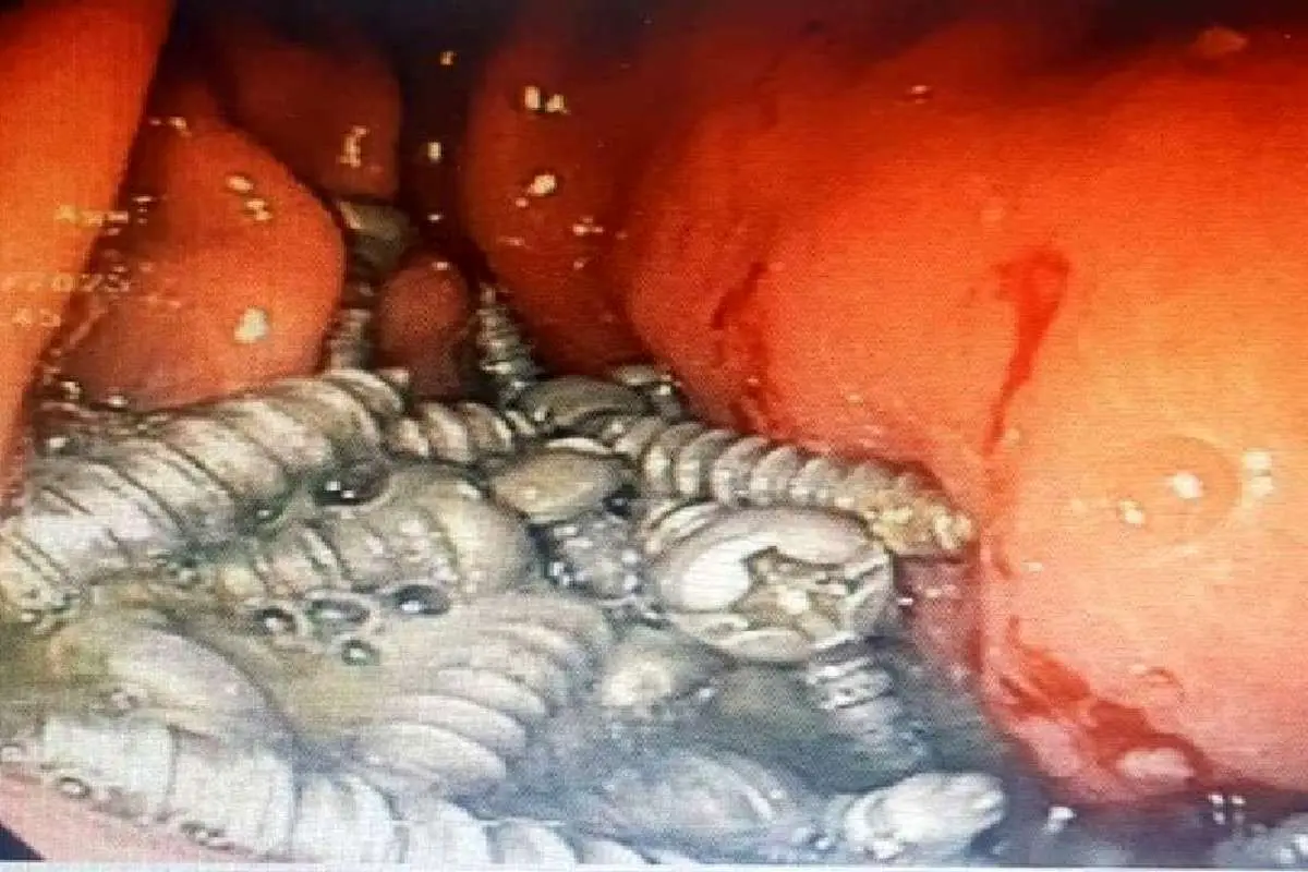 خارج کردن ۴۷ پیچ از معده یک بیمار در کرج!