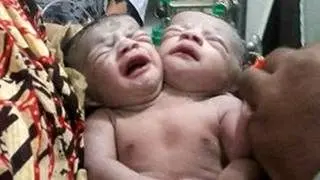 تولد نوزاد شگفت‌انگیز در بنگلادش با دو سر