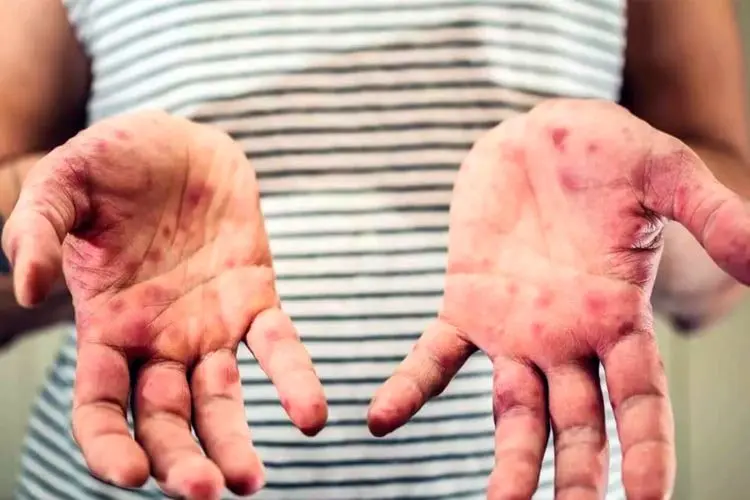 مدیرعامل خانه «ای بی»: ۹۵ درصد بیماران پروانه‌ای، حاصل ازدواج فامیلی هستند