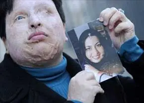 تکرار غصه غمناک اسیدپاشی در سال جدید+ تصاویر