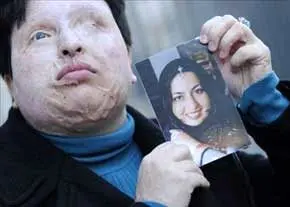 تکرار غصه غمناک اسیدپاشی در سال جدید+ تصاویر