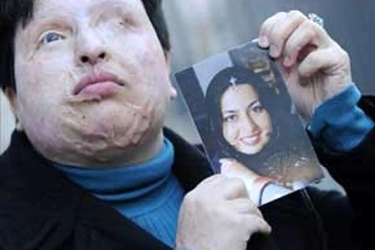 تکرار غصه غمناک اسیدپاشی در سال جدید+ تصاویر