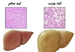 پرخوري پس از افطار، بيماري كبدچرب را تشديد مي‌كند