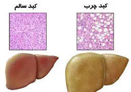 پرخوري پس از افطار، بيماري كبدچرب را تشديد مي‌كند